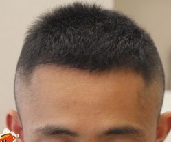 -大麦微针植发丨全国连锁