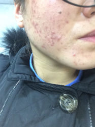 苗方清颜专业祛痘连锁机构(龙泽店)-苗方清颜专业祛痘