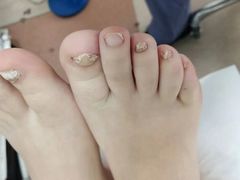 -世龙世家灰指甲鸡眼脚气甲沟炎跖疣护理(通州店)