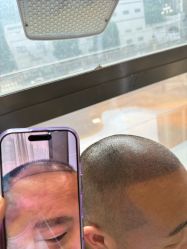 -碧莲盛·不剃发植发