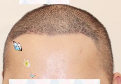 -大麦微针植发全国连锁