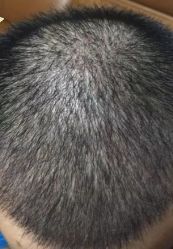 -大麦微针植发丨全国连锁