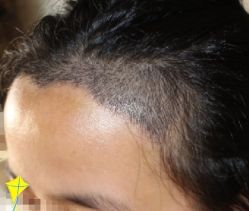 -大麦微针植发丨全国连锁