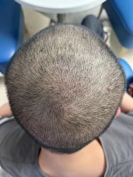 -大麦微针植发全国连锁