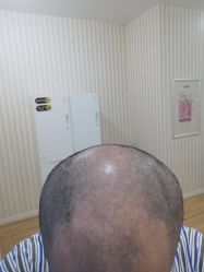 -碧莲盛·不剃发植发