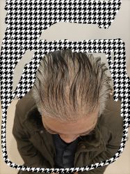 体验后-大麦微针植发丨全国连锁