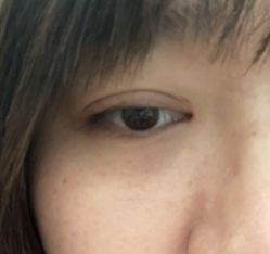 -天津健丽·去眼袋医疗美容机构