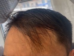 -碧莲盛·不剃发植发