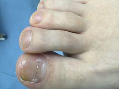 -Andrew指甲专科灰指甲·甲沟炎矫正·3D步态矫形鞋垫定制(浦三路店)