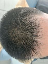 -大麦微针植发丨全国连锁