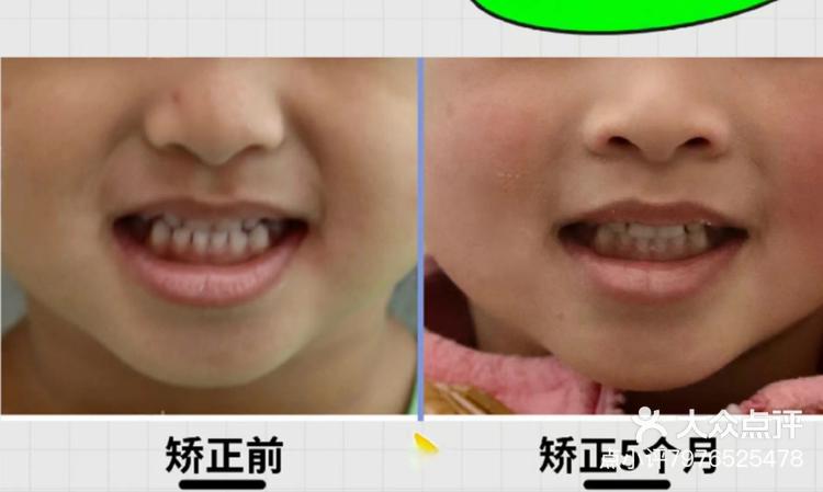 03 关注 为孩子绽放自信笑容,地包天矫正从现在开始地包天,俗称"兜齿