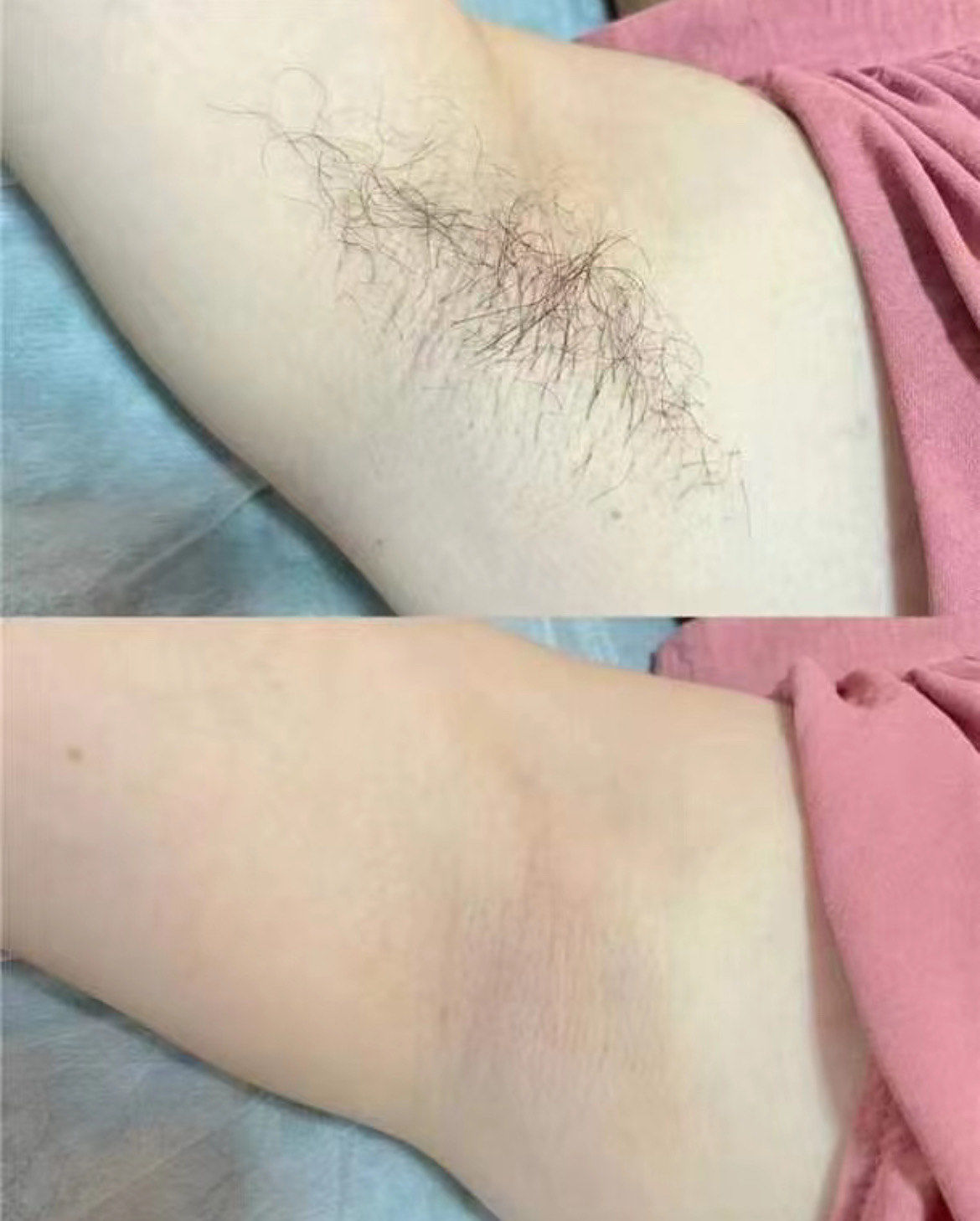 脱毛