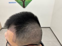 -北京雍禾植发医院