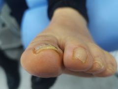-Andrew指甲专科灰指甲·甲沟炎矫正·3D步态矫形鞋垫定制(浦三路店)
