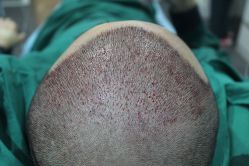 点击看大图 -大麦微针植发丨全国连锁