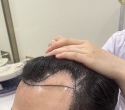 -碧莲盛·不剃发植发