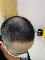 点击看大图 体验后-大麦微针植发丨全国连锁