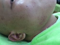 -苗医生草本科技祛痘