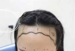 -大麦微针植发全国连锁