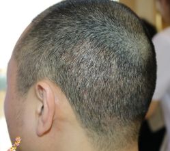 -大麦微针植发丨全国连锁
