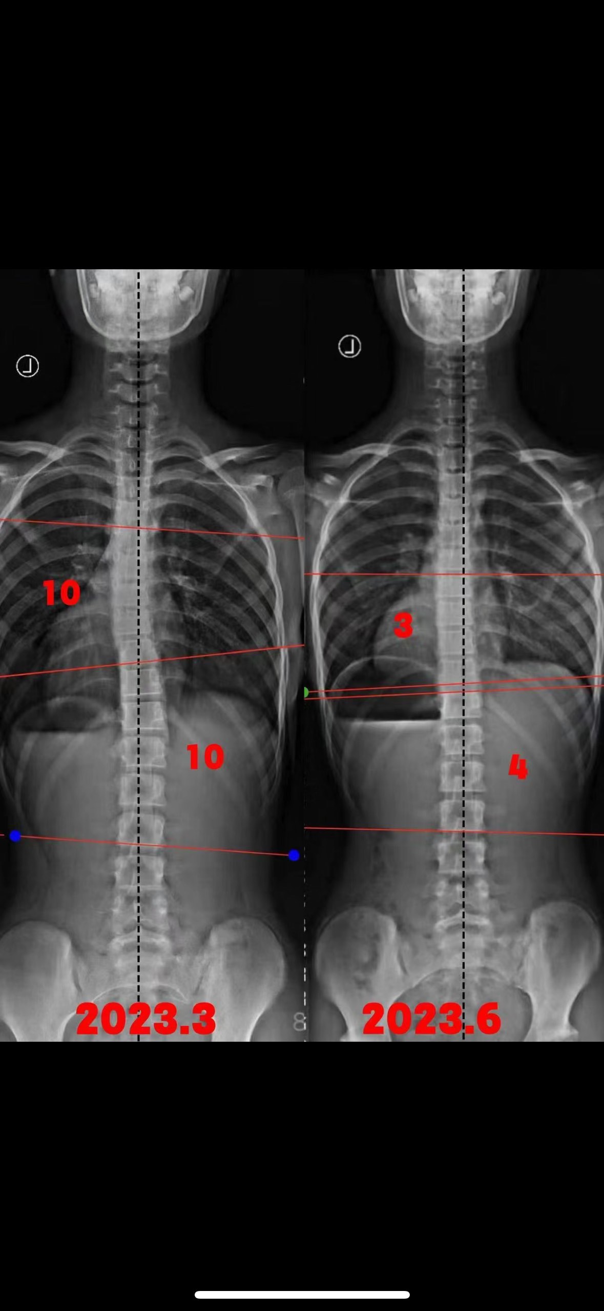 脊柱侧弯10度外观图片图片