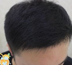 -大麦微针植发丨全国连锁