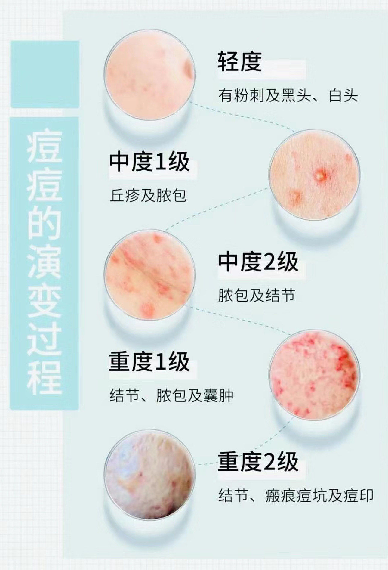 你的痘痘属于哪一个等级呢