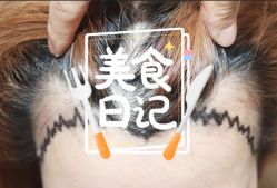 -大麦微针植发全国连锁