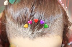 -大麦微针植发全国连锁