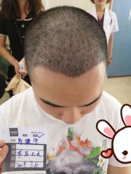 点击看大图 -大麦微针植发丨全国连锁