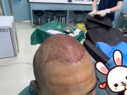 点击看大图 -大麦微针植发丨全国连锁