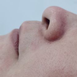 体验后-蕾特恩专业祛痘·皮肤管理