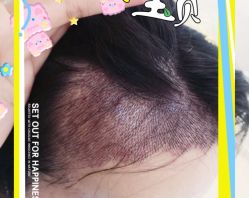 -大麦微针植发全国连锁