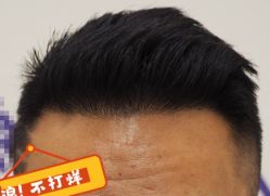 -大麦微针植发全国连锁