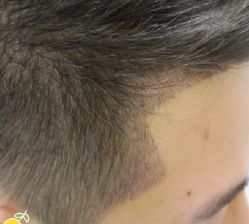 -大麦微针植发丨全国连锁