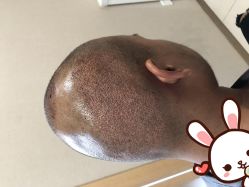 -大麦微针植发丨全国连锁