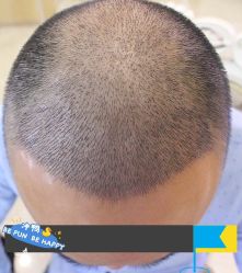 -大麦微针植发丨全国连锁