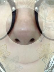 -成都苗方清颜专业祛痘
