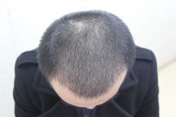 点击看大图 -大麦微针植发丨全国连锁