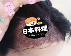 -大麦微针植发全国连锁