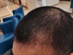 -碧莲盛·不剃发植发