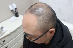 点击看大图 -大麦微针植发丨全国连锁