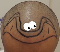 -大麦微针植发全国连锁