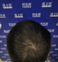 -碧莲盛·不剃发植发