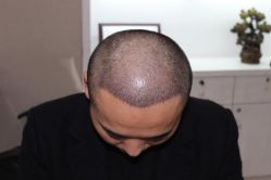 -大麦微针植发丨全国连锁