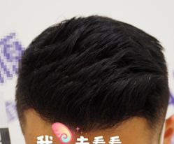 -大麦微针植发全国连锁