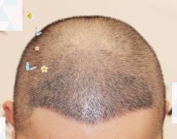 -大麦微针植发全国连锁