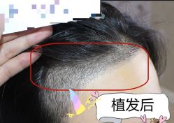 -大麦微针植发全国连锁