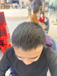 -大麦微针植发全国连锁
