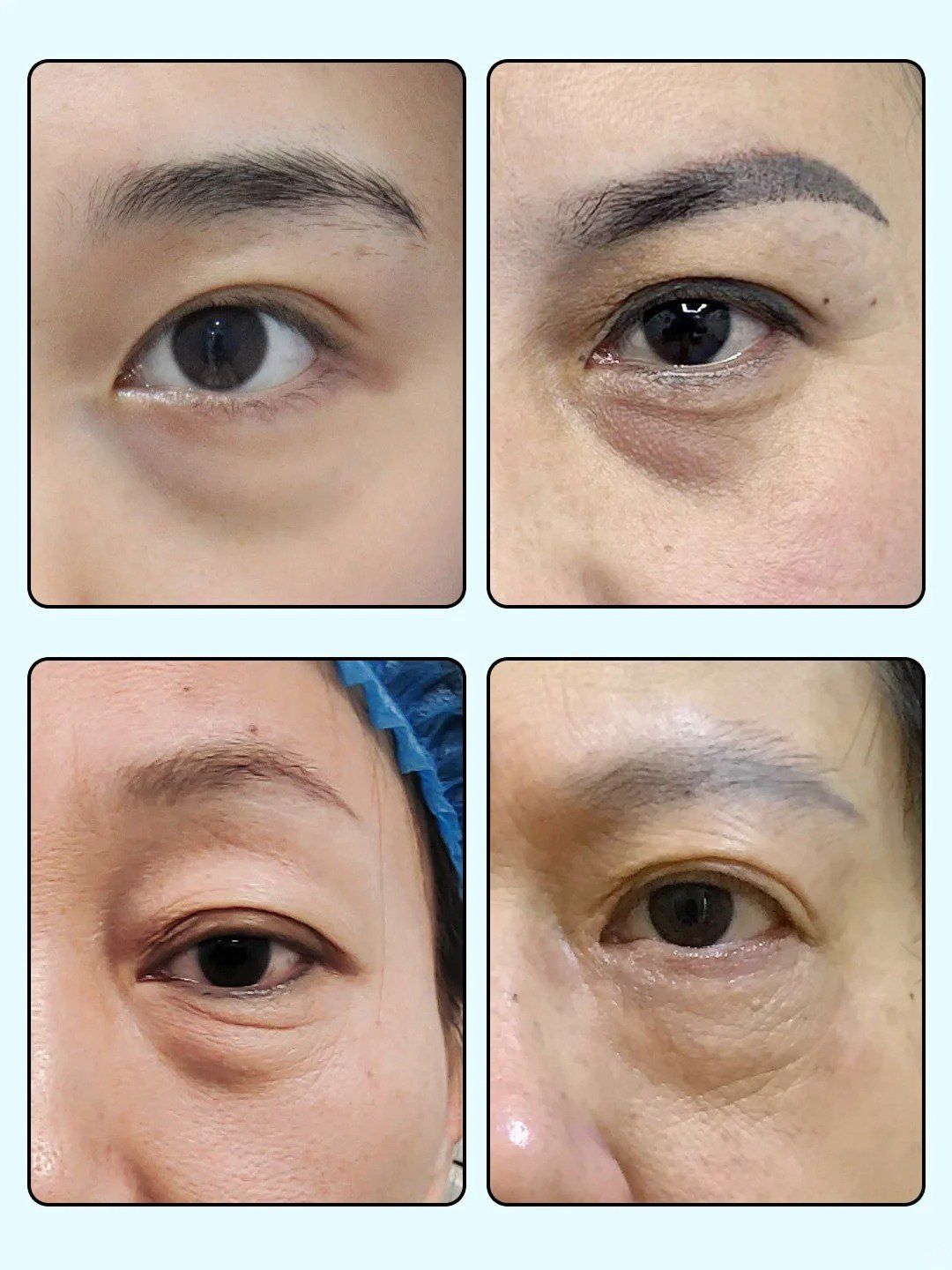 揭秘4种常见眼袋类型,你属于哪一种?
